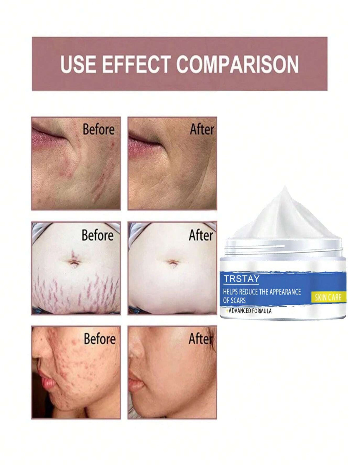 Skin Care Cream for Scars, Stretch Marks and Acne Skin, Scar Repair Cream for Scar Lightening and Skin Care