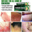 Psoriasis Cream - Herbal Plant Extracts