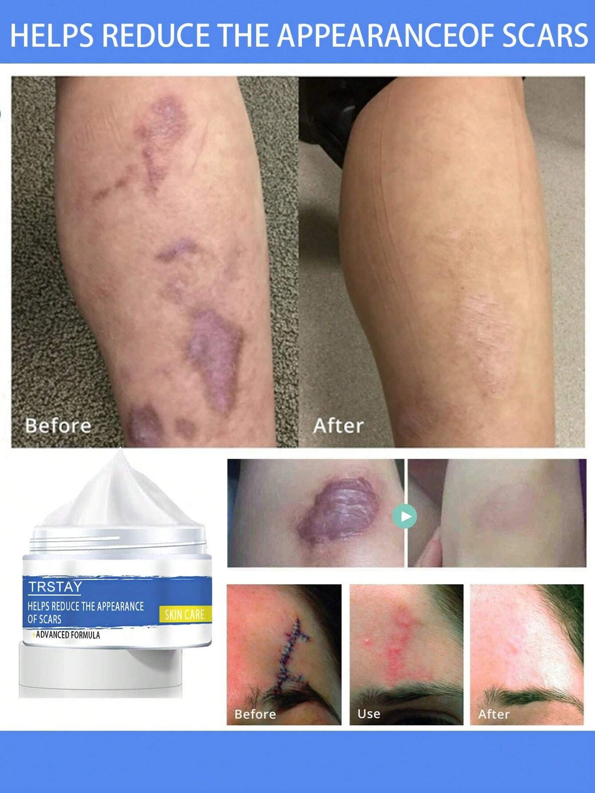 Skin Care Cream for Scars, Stretch Marks and Acne Skin, Scar Repair Cream for Scar Lightening and Skin Care