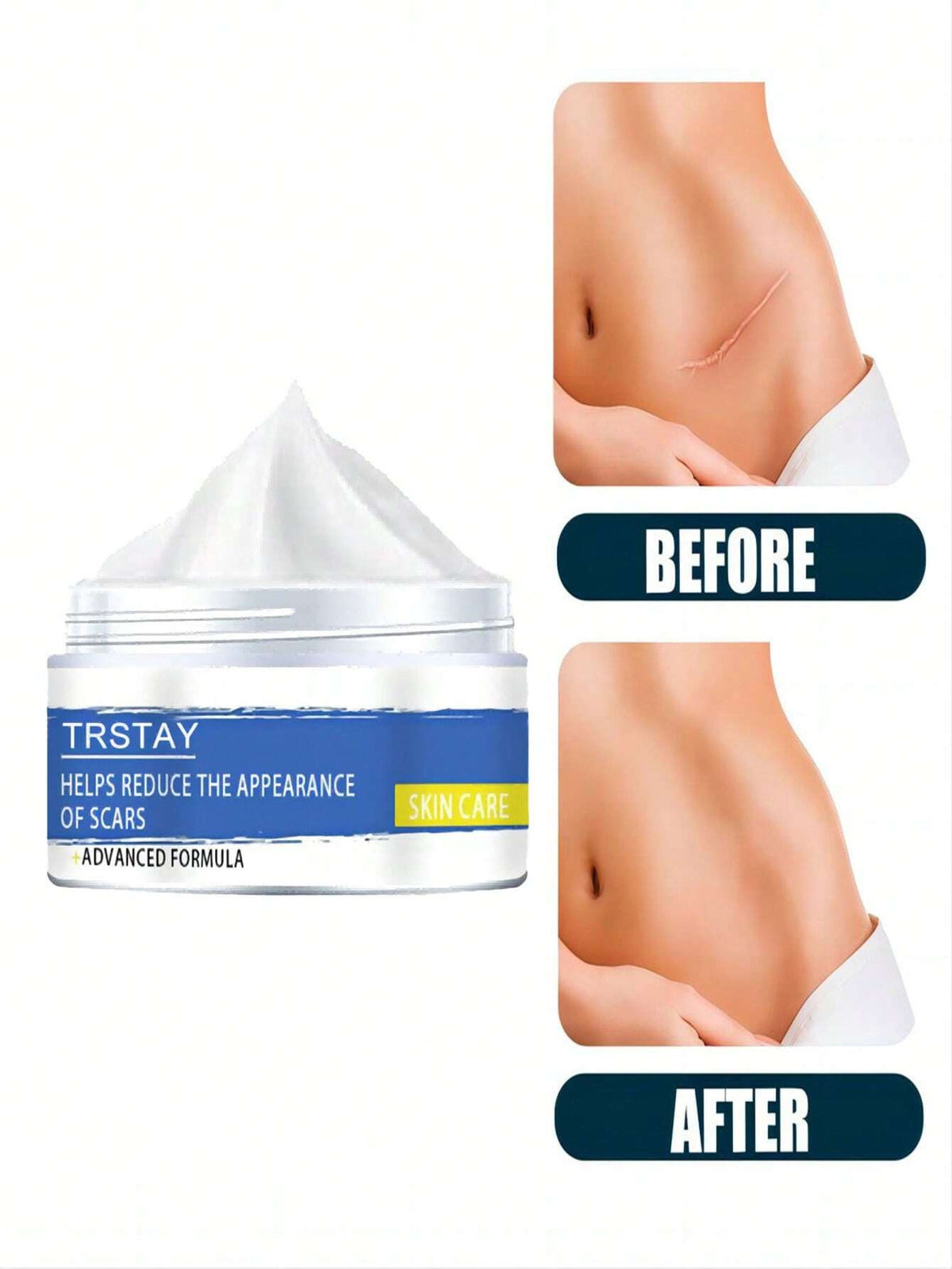 Skin Care Cream for Scars, Stretch Marks and Acne Skin, Scar Repair Cream for Scar Lightening and Skin Care