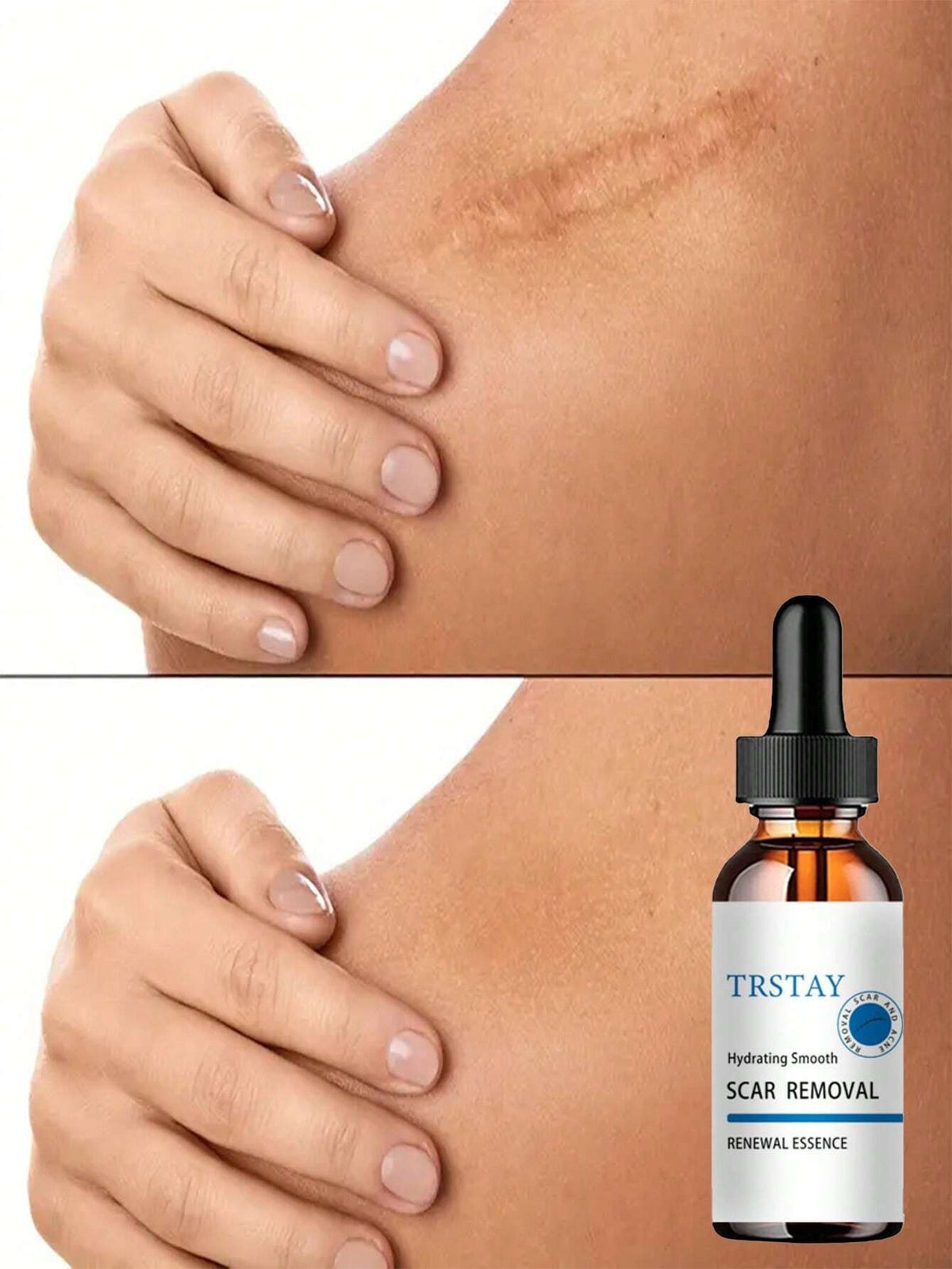 Scar Removal Moisturizer for Smooth Skin